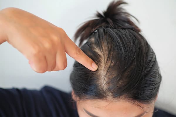 Woman-with-thin-hair-caused-by-hair-loss-symptoms.